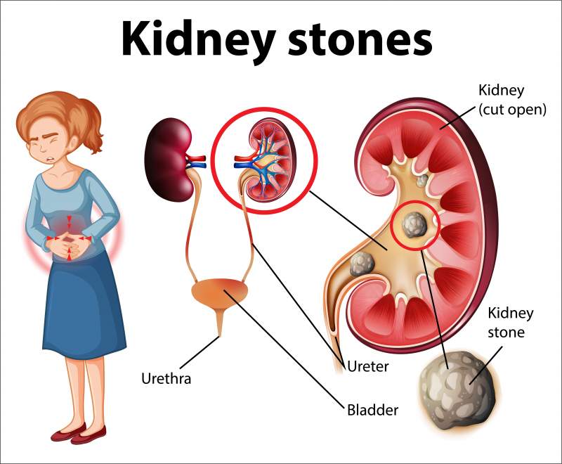 Informative illustration of kidney stones