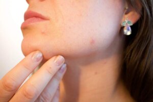 acne-pores-skin-pimple-female