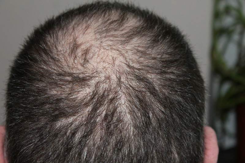 man-hair-loss-head