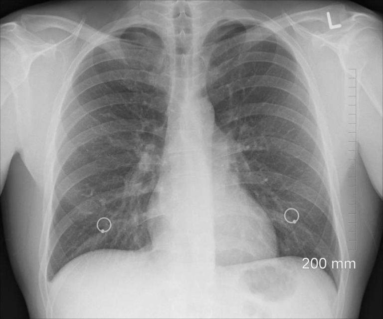 diagnosis-xray-chest-lungs-ribs