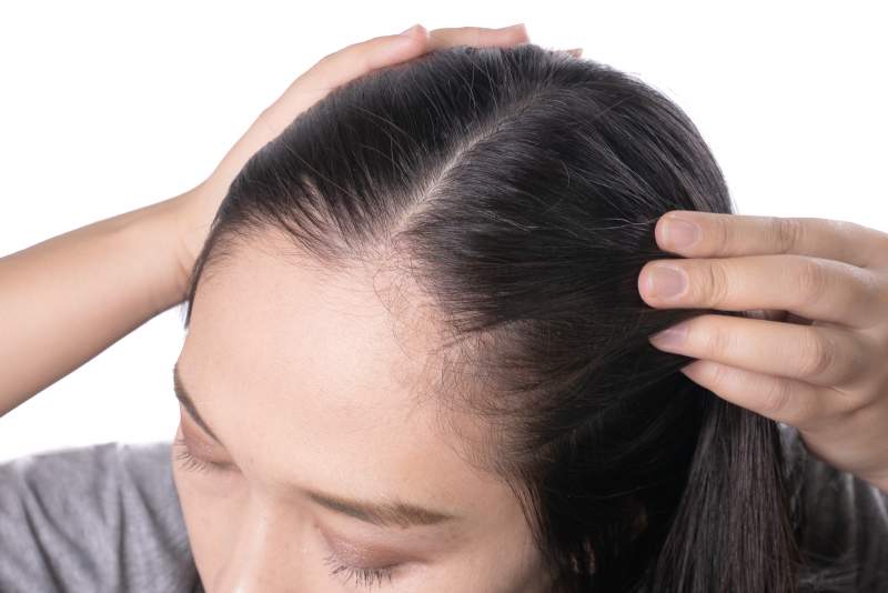 Young asian women worry about problem hair loss, head bald, dandruff