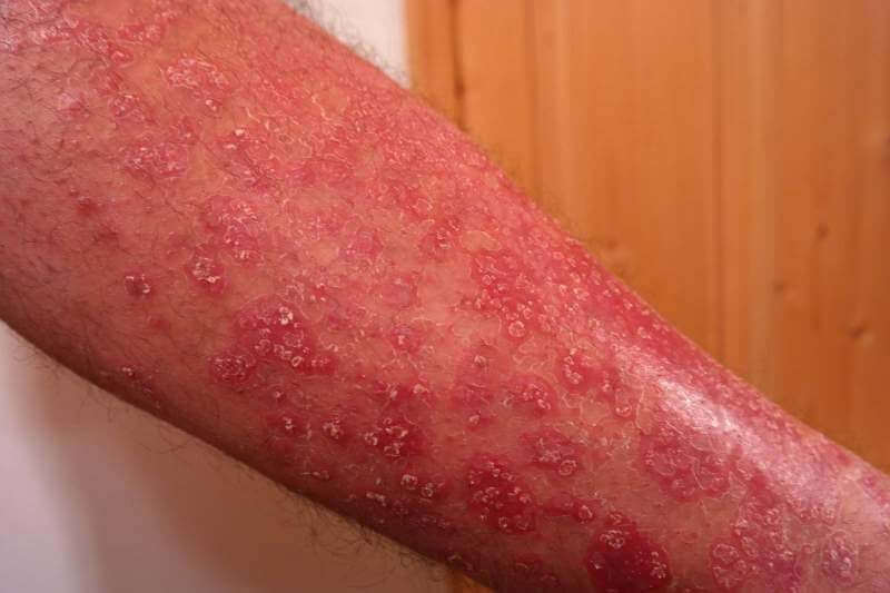 psoriasis-skin-disease