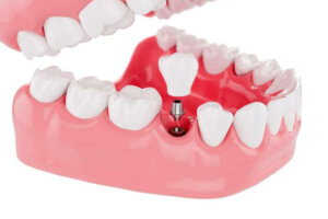 implants teeth health care