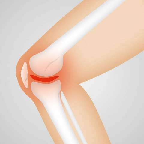 arthrocalman-osteoarthritis-knee